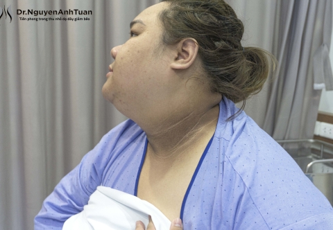 Béo phì và hội chứng gai đen: Hiểu đúng để phòng ngừa và điều trị hiệu quả